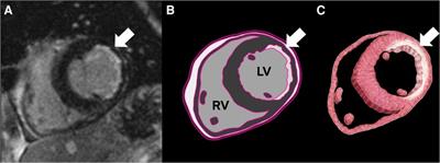 Cardiac MRI assessment of myocardial viability in chronic myocardial infarction: how should we do it?